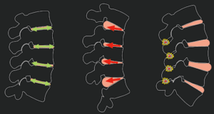 Balanced Spinal Discs